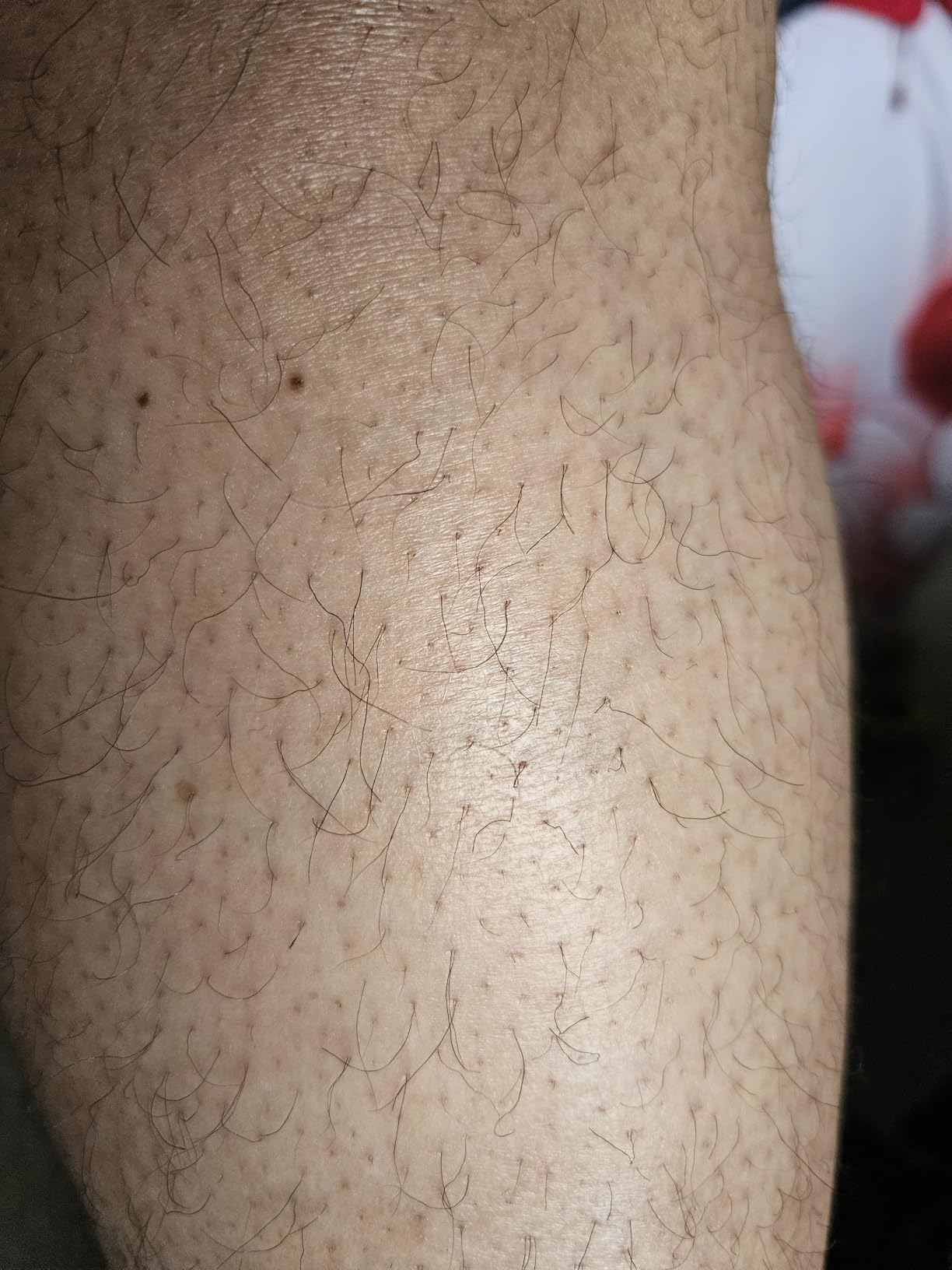 Ulike Laser Hair Removal Device Air 10 IPL Gift for Women and Men, Ice cool and Permanent hair Reduction for Nearly Painless, Dual Lights, Skin Sensor & USHR Mode Hair Removal in 10mins from Home customer photo 1